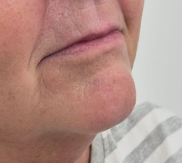 Front view of client's lips and chin after dermal filler treatment