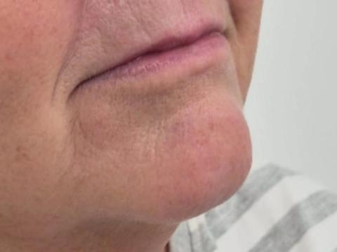 Front view of client's lips and chin after dermal filler treatment