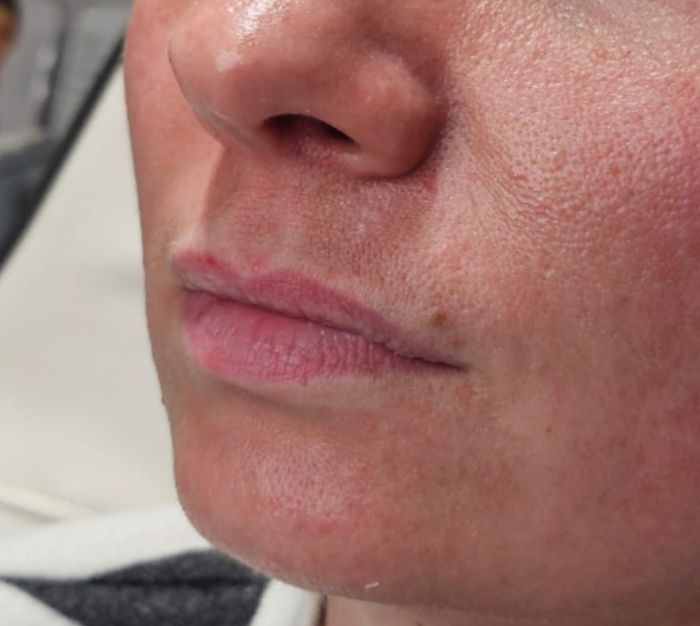 Side profile of client's lips after dermal filler treatment