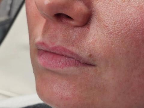 Side profile of client's lips after dermal filler treatment