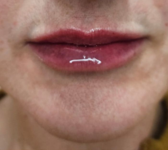 Front view of client's lips and chin before dermal filler treatment