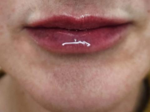 Front view of client's lips and chin before dermal filler treatment