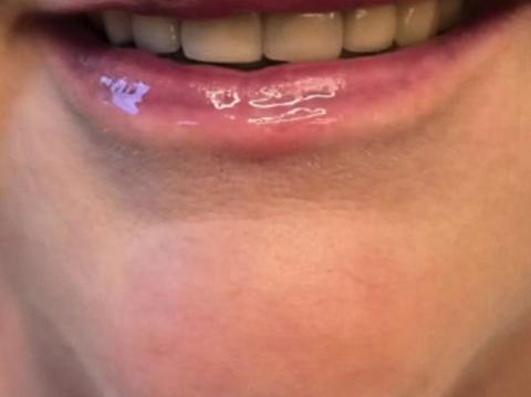 Front view of client's smile before dermal filler treatment