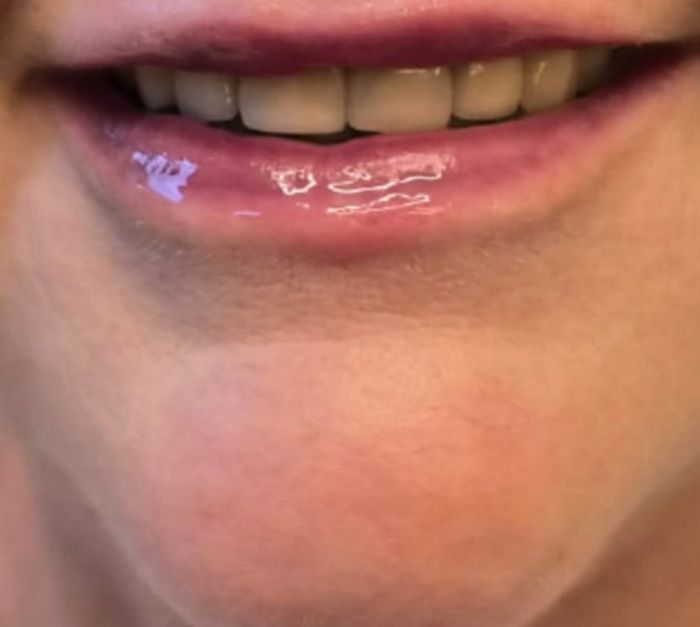 Front view of client's smile before dermal filler treatment