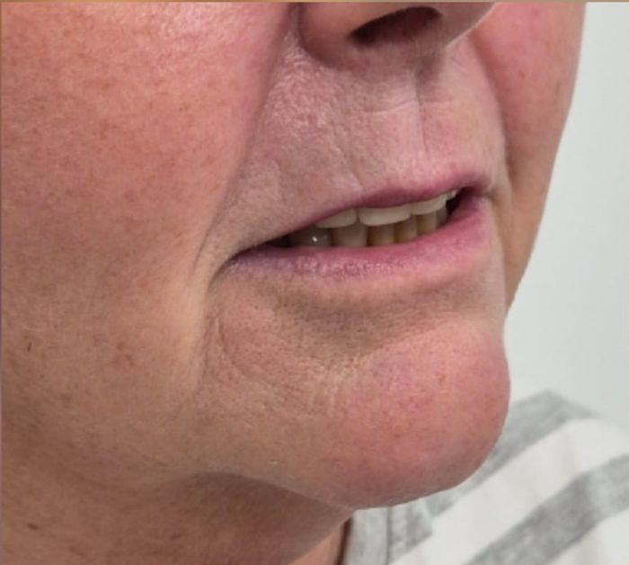 Side profile of client's jawline and chin after dermal filler treatment