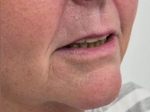 Side profile of client's jawline and chin after dermal filler treatment