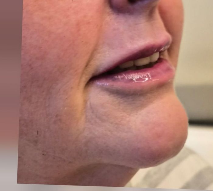 Side profile of client's jawline and chin before dermal filler treatment