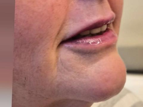 Side profile of client's jawline and chin before dermal filler treatment