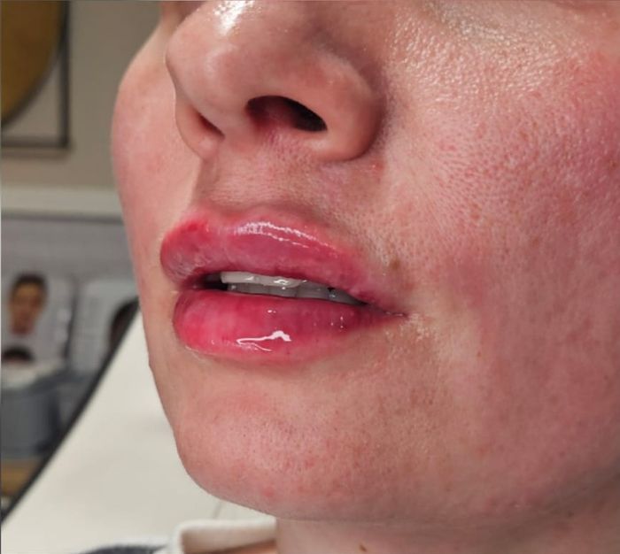 Side profile of client's lips before dermal filler treatment