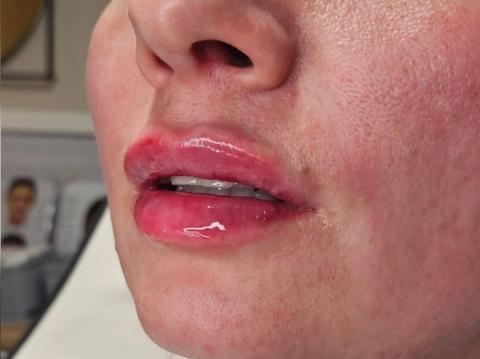 Side profile of client's lips before dermal filler treatment