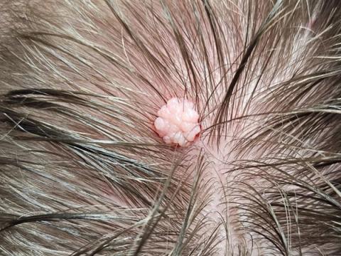 Raised skin growth on the scalp before diathermy removal