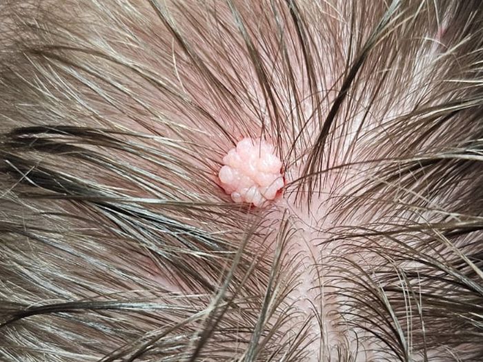 Raised skin growth on the scalp before diathermy removal