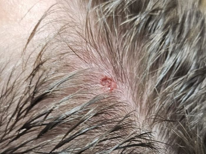 Scalp area healing shortly after diathermy removal