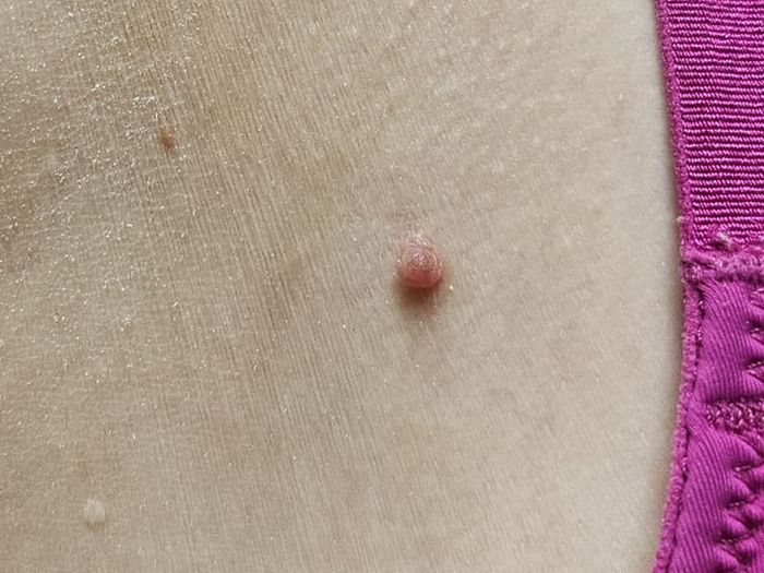 Skin tag under the arm before diathermy removal