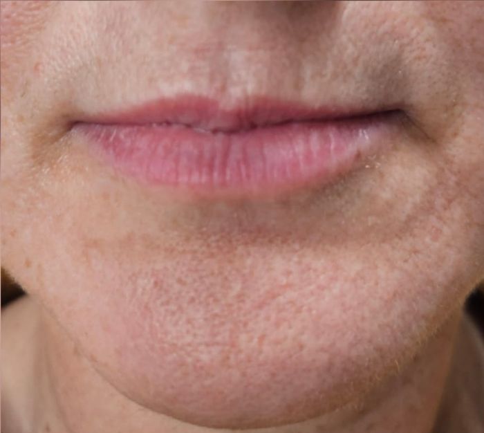 Front view of client's lips and chin after dermal filler treatment