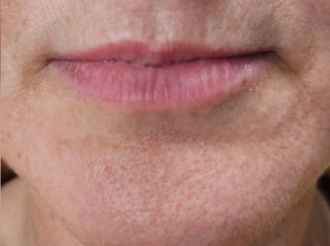 Front view of client's lips and chin after dermal filler treatment