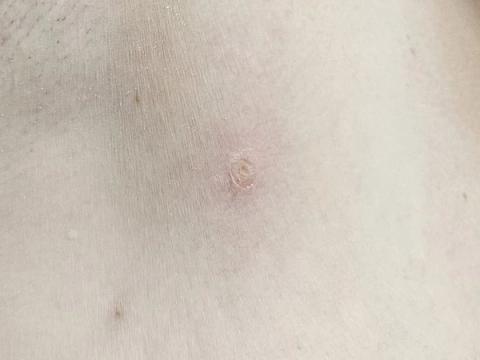 Underarm skin healing shortly after diathermy removal