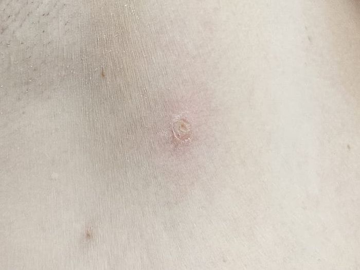 Underarm skin healing shortly after diathermy removal