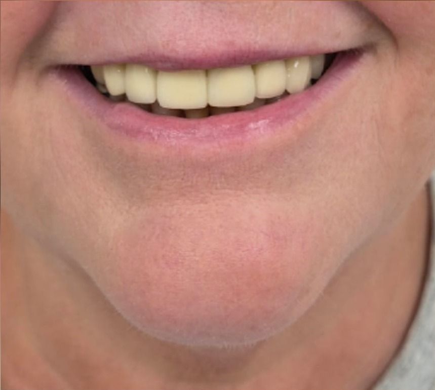 Front view of client's smile after dermal filler treatment