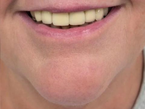 Front view of client's smile after dermal filler treatment