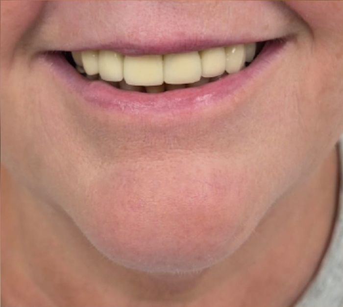 Front view of client's smile after dermal filler treatment