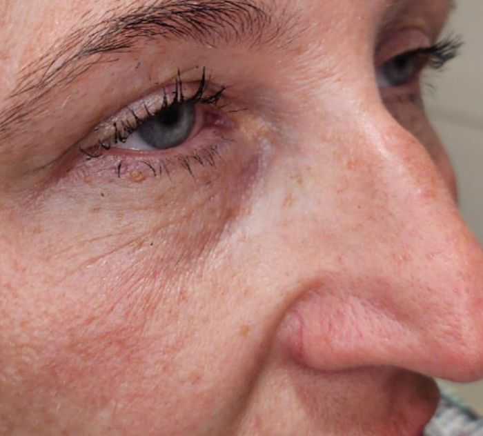 Side angle of client's under-eye area after dermal filler treatment