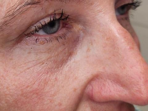Side angle of client's under-eye area after dermal filler treatment