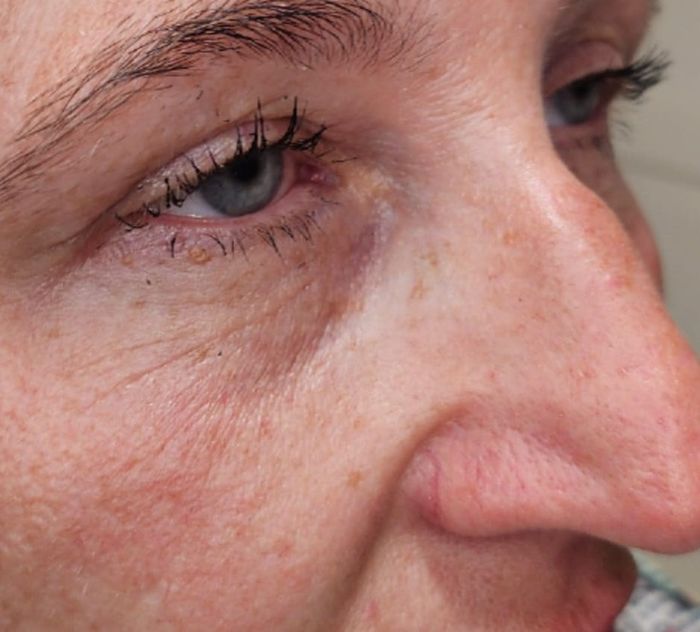 Side angle of client's under-eye area after dermal filler treatment