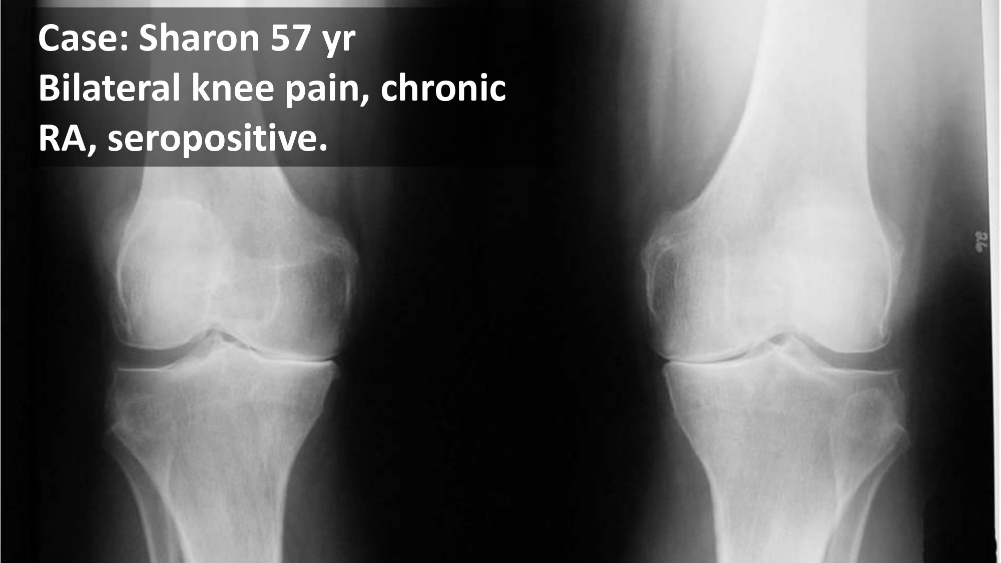 Nevada Rheumatology April 2025 Nisha Manek