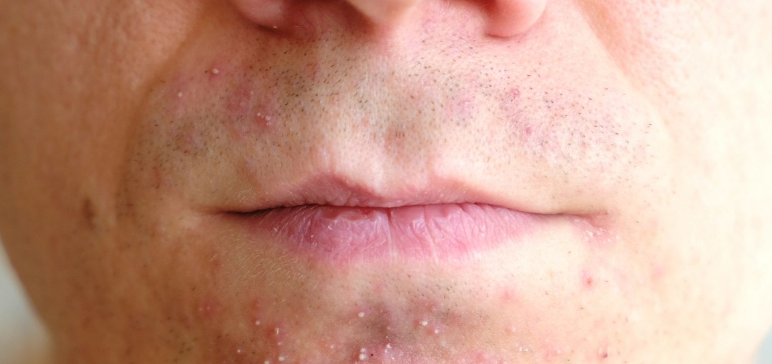 Zapalenie okołoustne – Dermatitis Perioralis