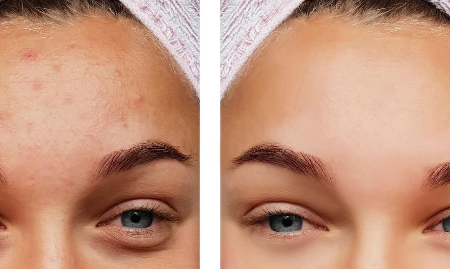 BioRePeel – terapeutyczny peeling całoroczny