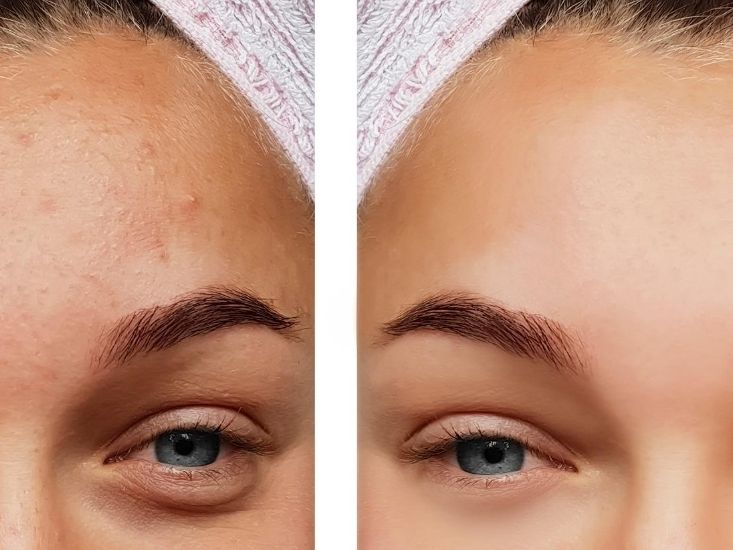 BioRePeel – terapeutyczny peeling całoroczny