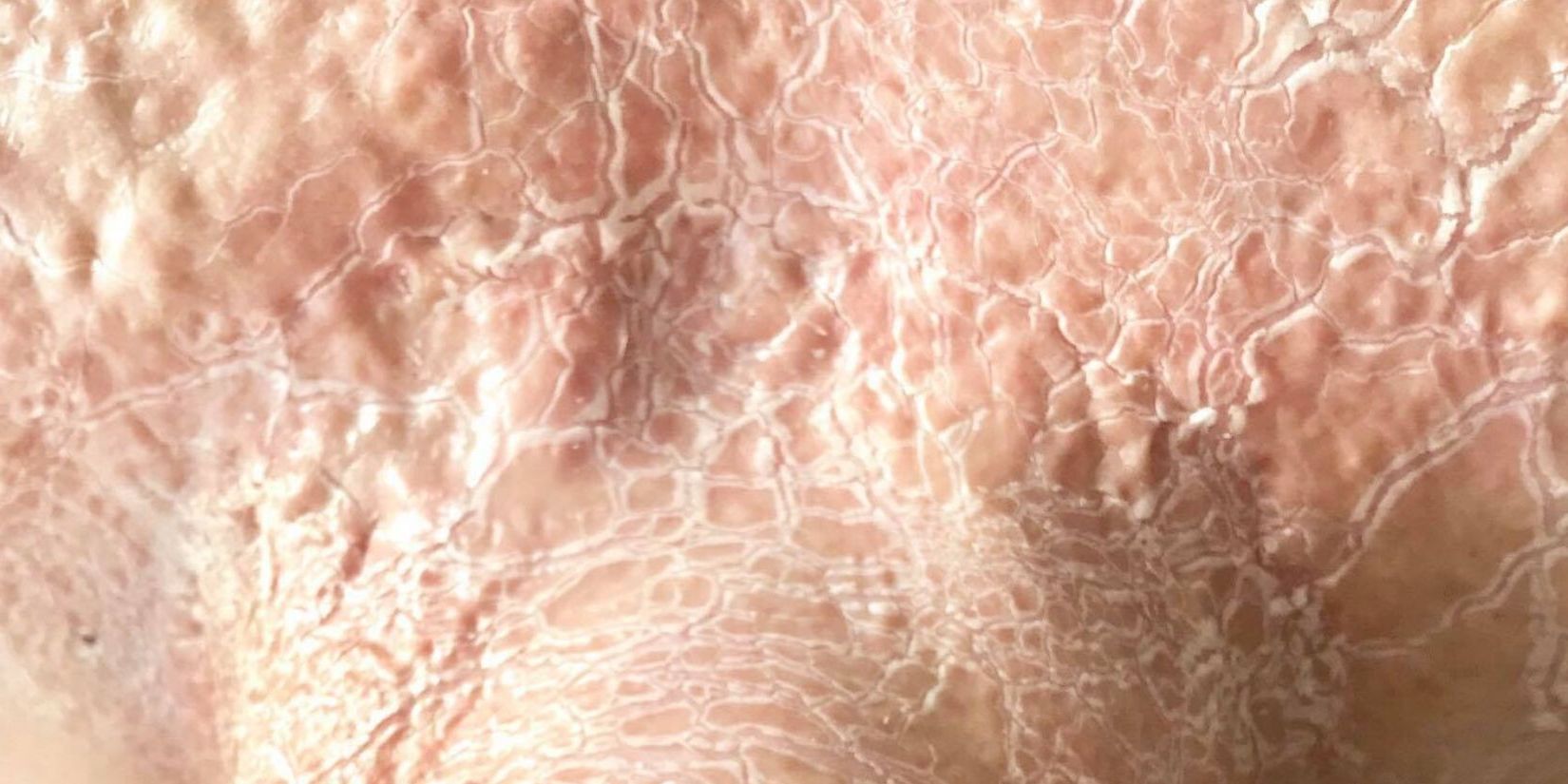 Paramedyczne zabiegi enzymatyczne