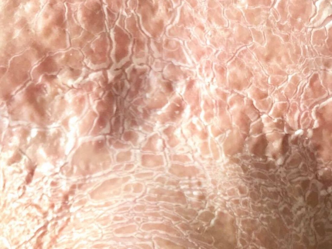 Paramedyczne zabiegi enzymatyczne