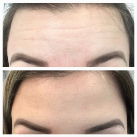 Botox - wygląd po