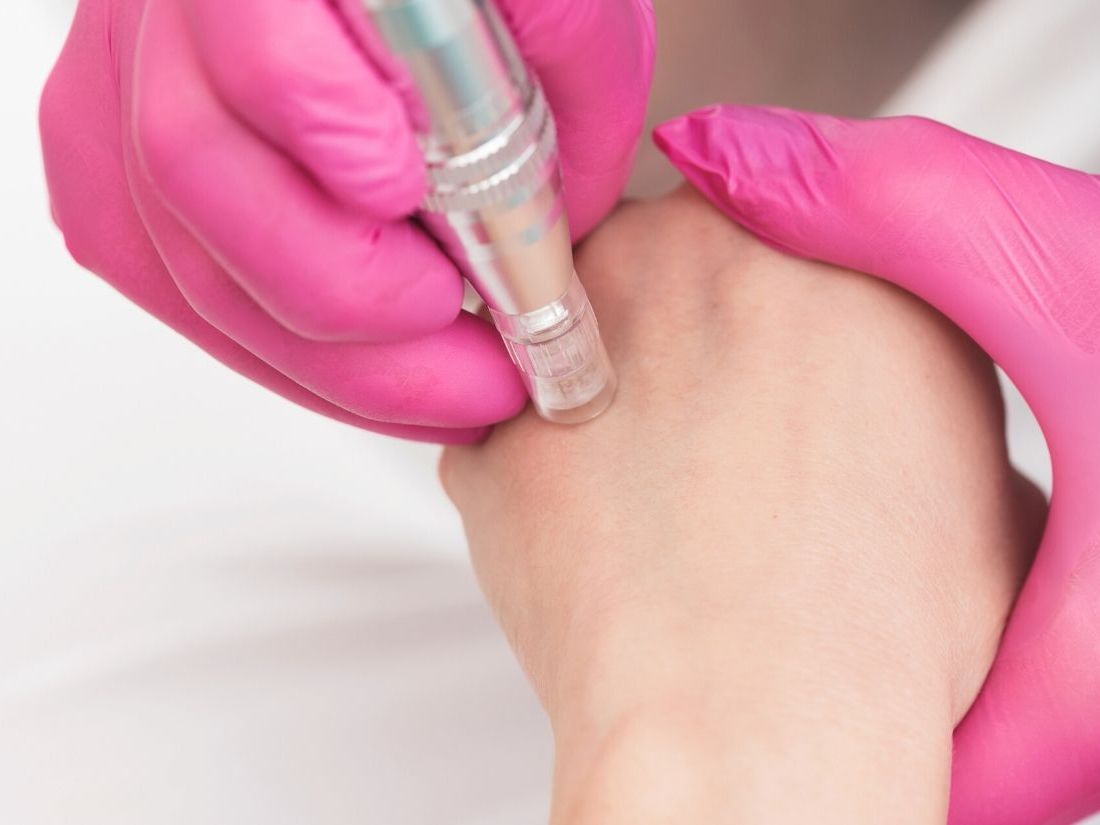 Mezoterapia mikroigłowa - zdjęcie podglądowe