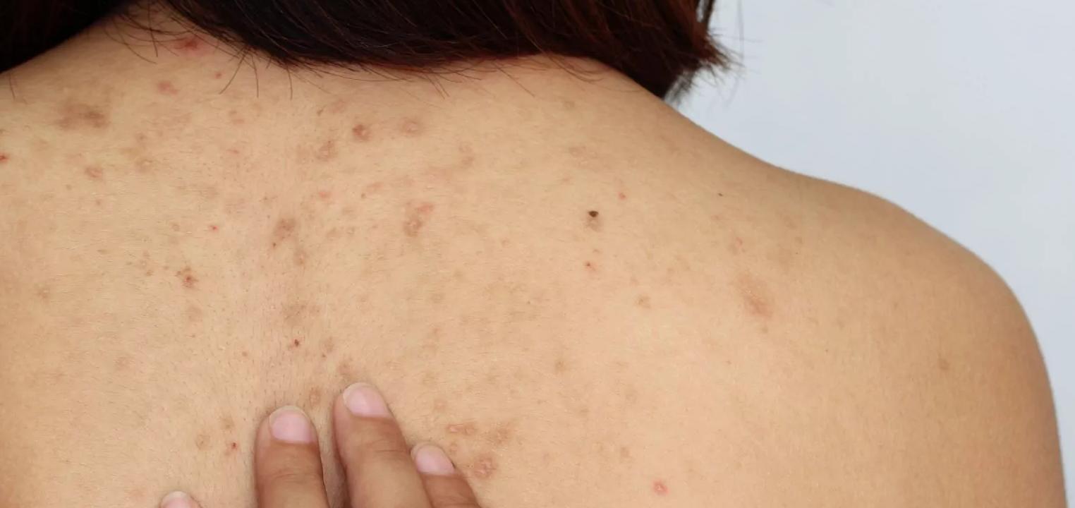 Back Acne – trądzik na plecach