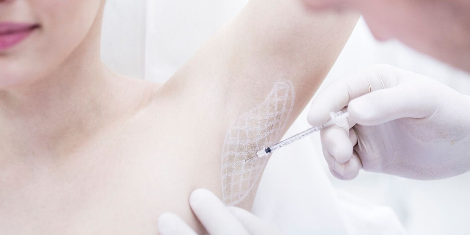 Botox - likwidacja nadpotliwości pach