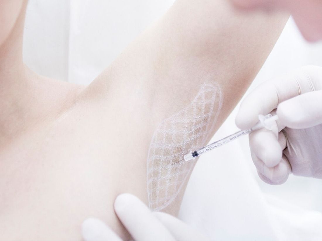 Botox - likwidacja nadpotliwości pach