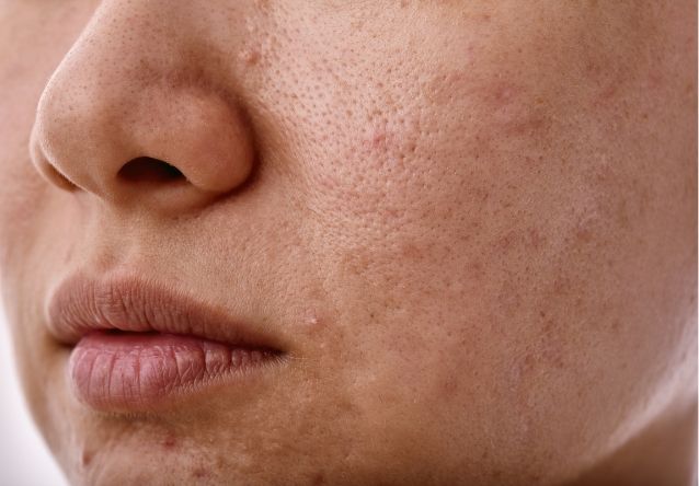 uszkodzona bariera skórna