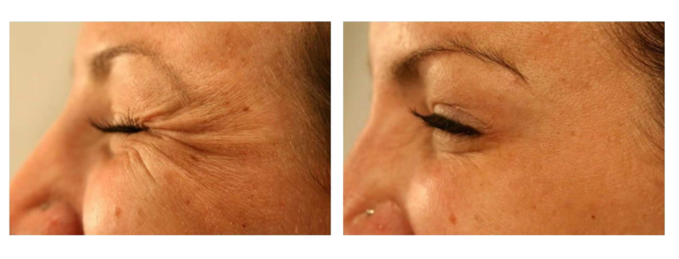 Botox efekty