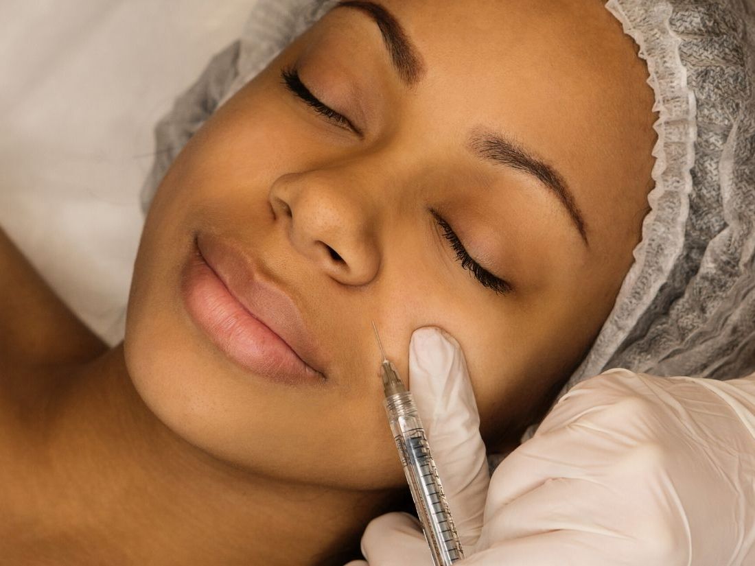 Wypełnianie, usuwanie zmarszczek kwasem hialuronowym