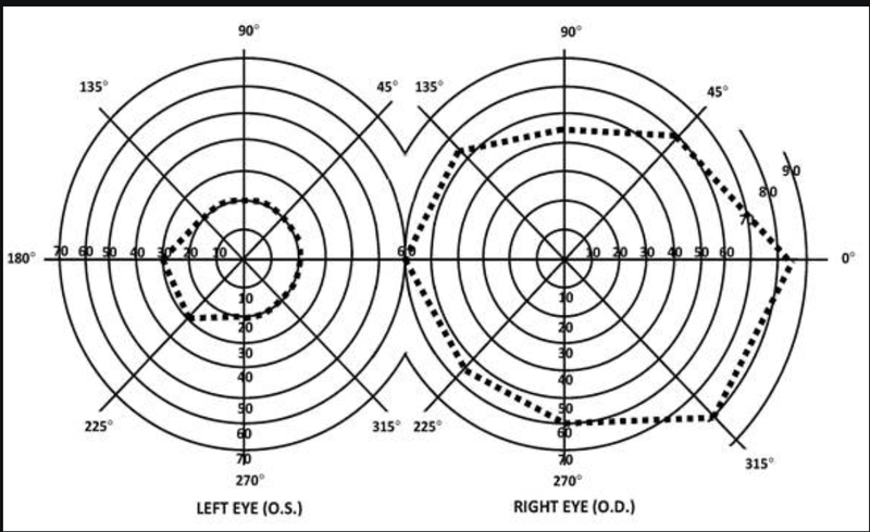Kinetic perimetry test result