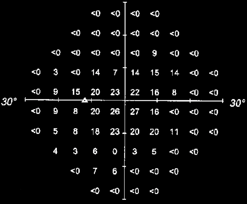dB printout from Humphrey test