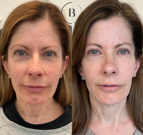 Collagen Restoration before and after results at Boujee Nurse