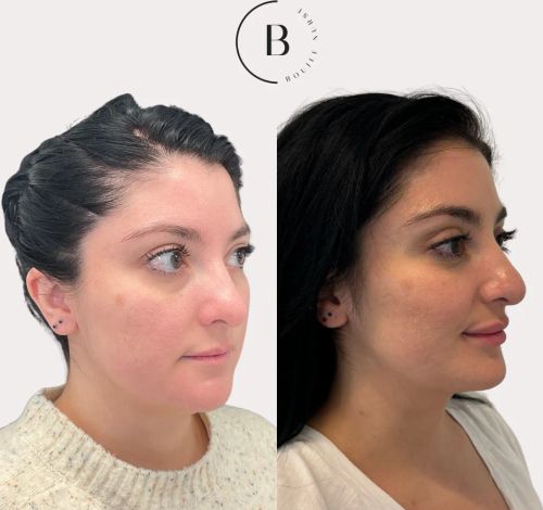 Full Facial Balancing before and after results at Boujee Nurse