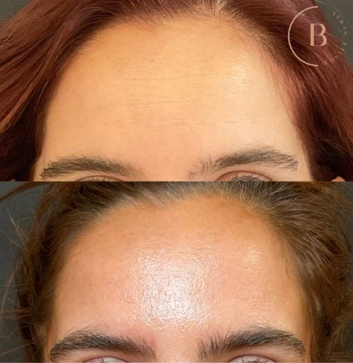 Letybo before and after results at Boujee Nurse