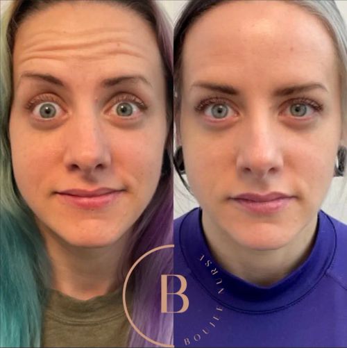 Letybo before and after results at Boujee Nurse
