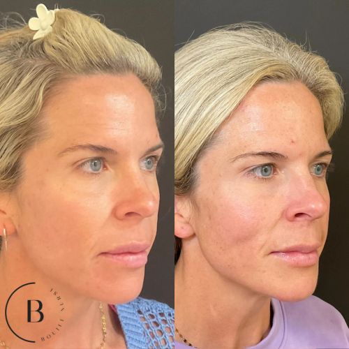 Volume Restoration before and after results at Boujee Nurse