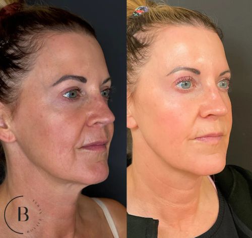 Laser Skin Renewal before and after results at Boujee Nurse